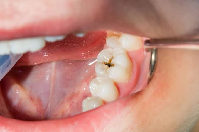 How to Prevent Cavities: A Complete Oral Care Guide