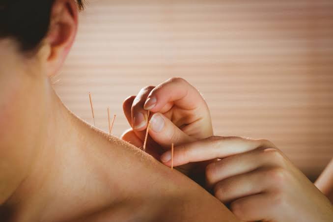How Acupuncture Helps with Pain and Stress Relief