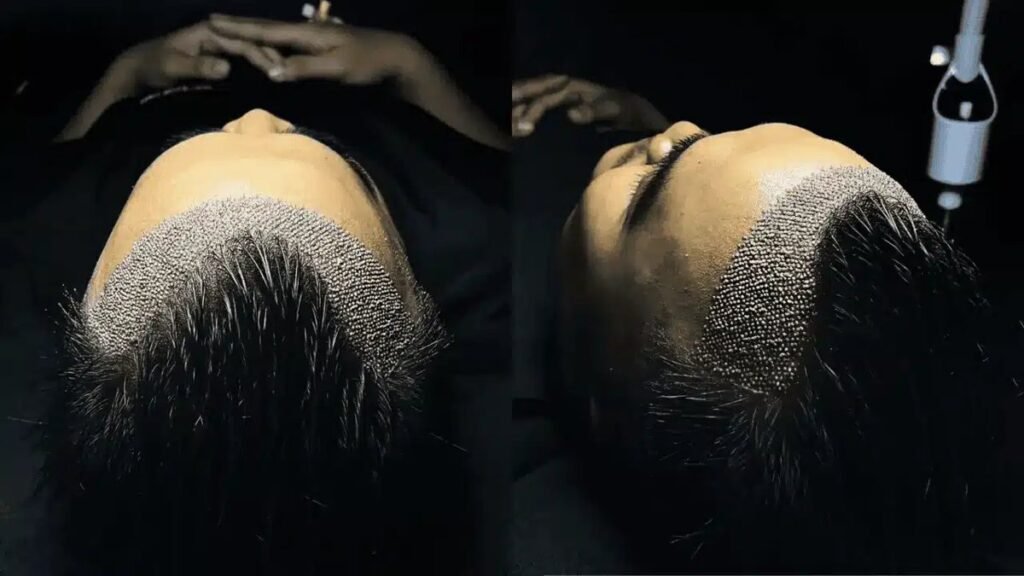 no shave hair transplant