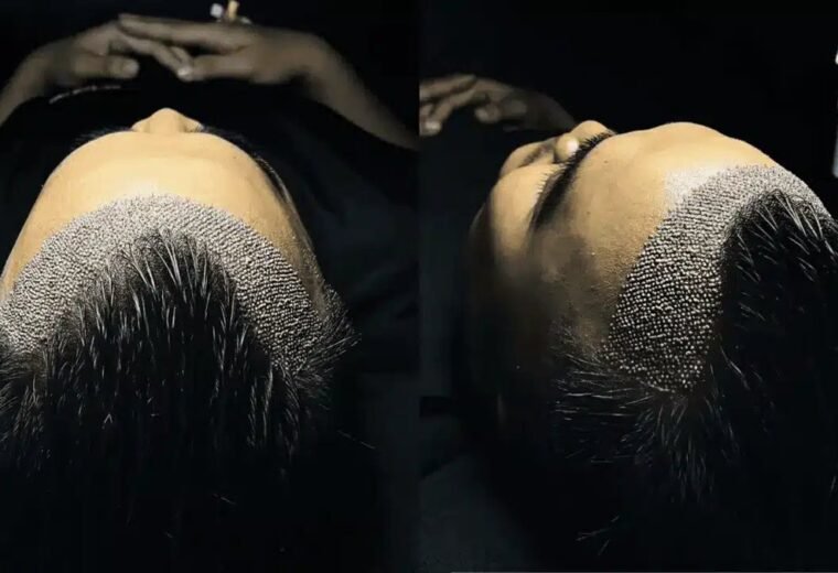 no shave hair transplant